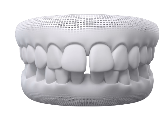 diastema