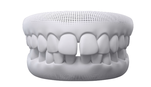 diastema