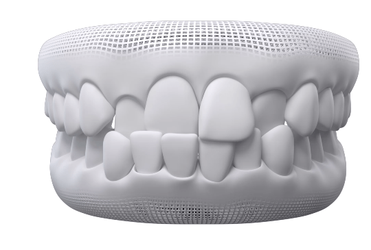 invisalign-mordida-cruzada