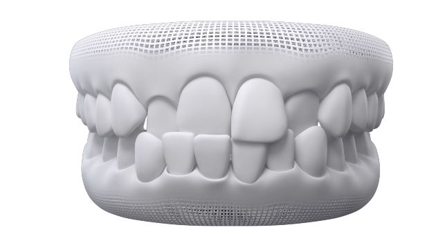 invisalign-mordida-cruzada